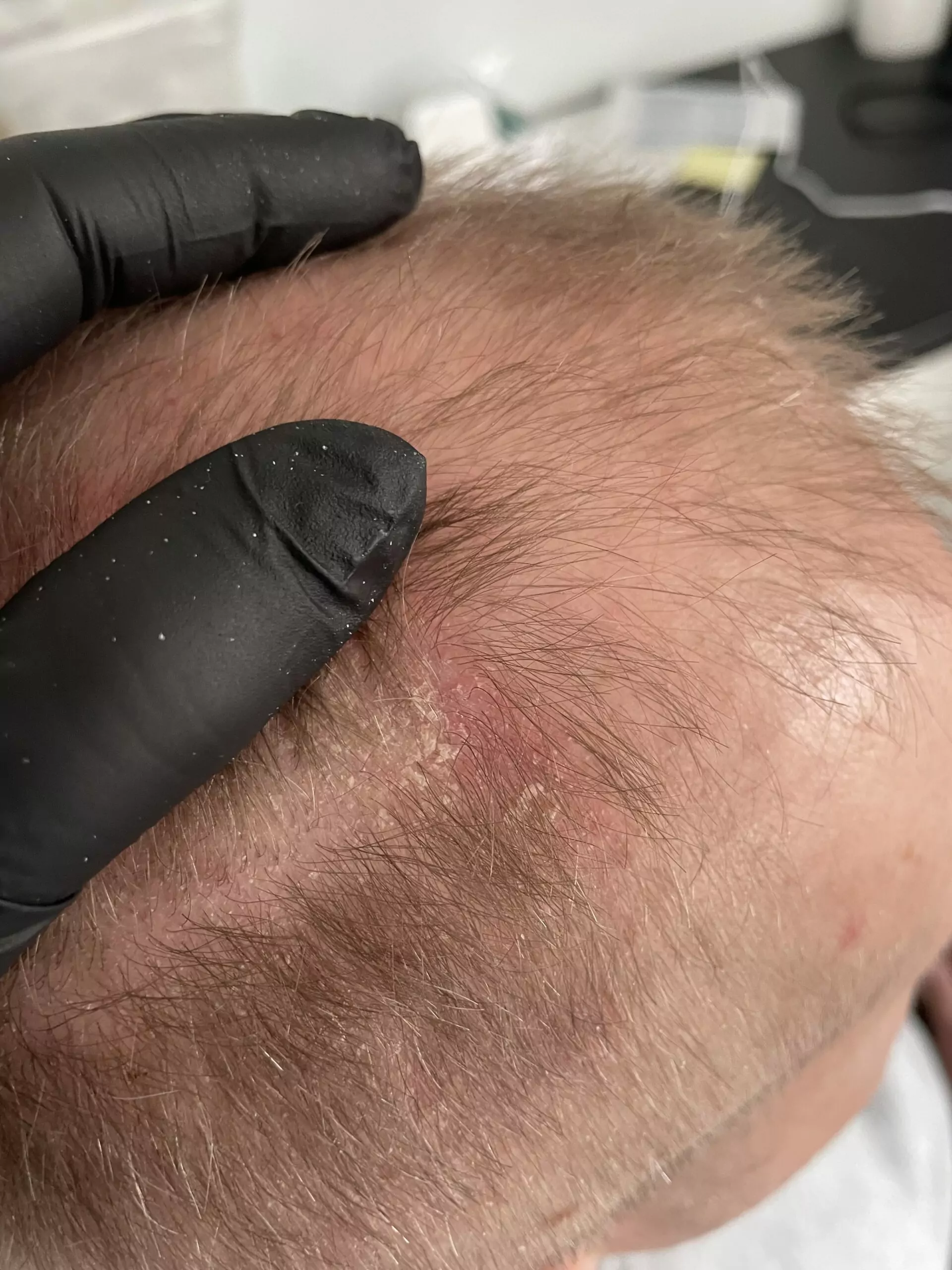 Trycholog dla mężczyzn Trycholog Bydgoszcz – Milena Kwaśniewska, specjalizuję się w diagnostyce i leczeniu problemów skóry głowy oraz włosów, oferując profesjonalne konsultacje i indywidualnie dobrane terapie. Nowa 15, 85-119 Bydgoszcz https://milena-trycholog.pl